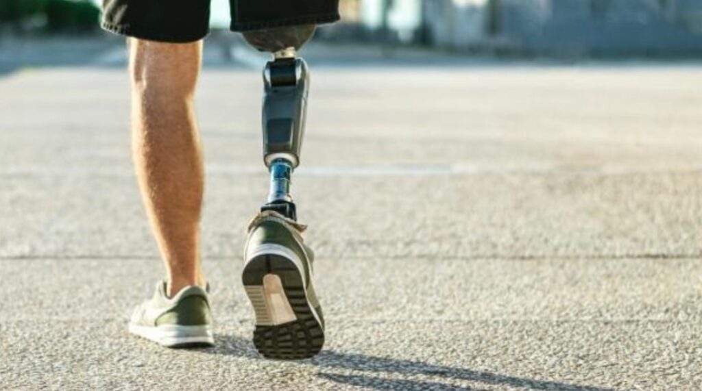 Amputation Injuries and Their Impact