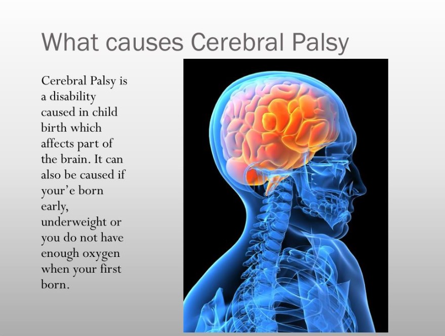 Causes of Cerebral Palsy