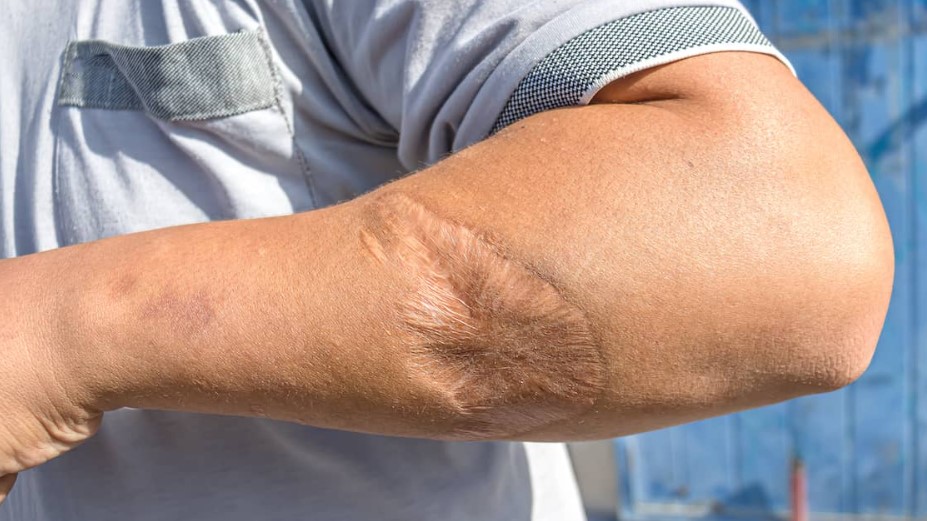 Dog Bite and Animal Attack Injury