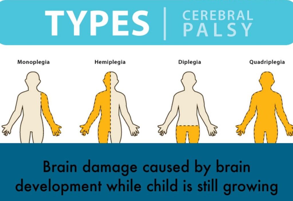 Types of Cerebral Palsy